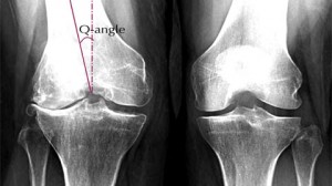 Joint pain and aging